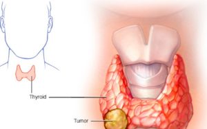 Mô bệnh học và chẩn đoán giai đoạn Ung thư tuyến giáp