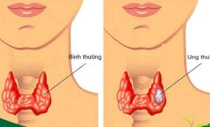 Đánh giá yếu tố nguy cơ tái phát trong Ung thư tuyến giáp thể biệt hóa