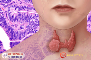 Ung thư tuyến giáp thể không biệt hóa (Anaplastic thyroid carcinoma – ATC)