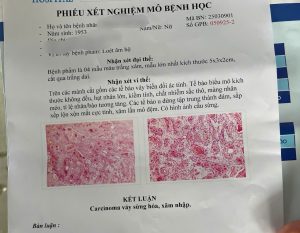 UNG THƯ ÂM HỘ: HIỂU ĐỂ PHÁT HIỆN SỚM VÀ ĐIỀU TRỊ HIỆU QUẢ
